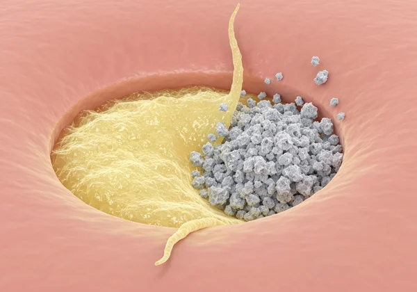 Pandangan mikroskopik pori dengan sebum dan sel kulit mati.