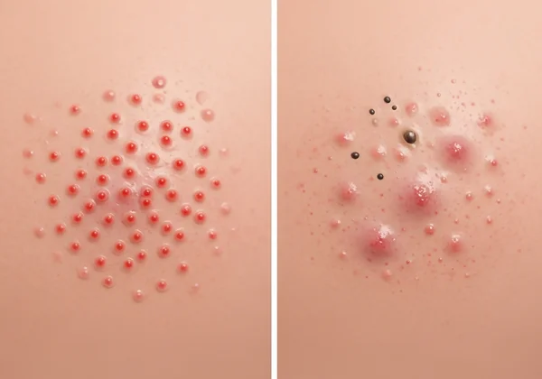 Visual comparison of fungal acne vs bacterial acne on skin.